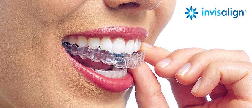 Invisalign - nevidljivi aparatić za zube